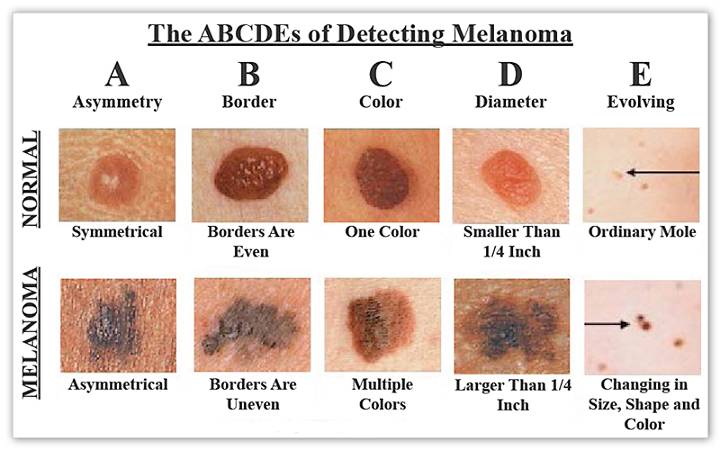 Melanoma ABCDE